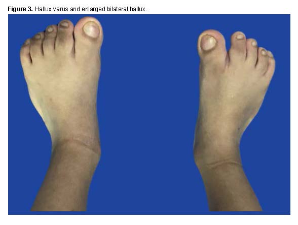 Hallux varus in Apert syndrome.